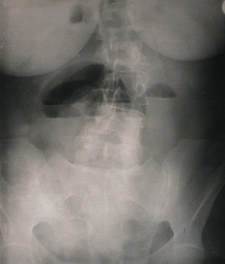 Radiografie abdominala pe gol in ortostatism.